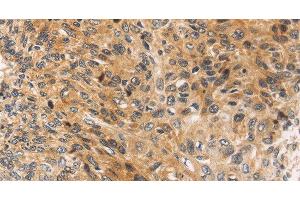 Immunohistochemistry of paraffin-embedded Human esophagus cancer using JNK2 Polyclonal Antibody at dilution of 1:30 (JNK2 Antikörper)