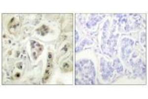 Immunohistochemical analysis of paraffin-embedded human lung carcinoma tissue using HSP60 antibody. (HSPD1 Antikörper)