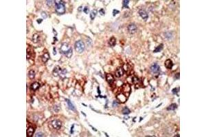IHC analysis of FFPE human hepatocarcinoma tissue stained with the EZH2 antibody (EZH2 Antikörper)