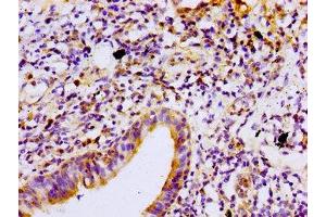 Immunohistochemistry of paraffin-embedded human lung cancer using ABIN7165698 at dilution of 1:100 (PKC beta Antikörper  (AA 517-643))