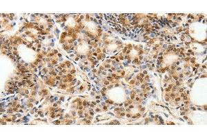 Immunohistochemistry of paraffin-embedded Human thyroid cancer using PDCD6 Polyclonal Antibody at dilution of 1:30 (PDCD6 Antikörper)