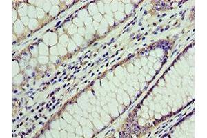 Immunohistochemistry of paraffin-embedded human colon cancer using ABIN7145038 at dilution of 1:100 (ATAD3A Antikörper  (AA 1-240))