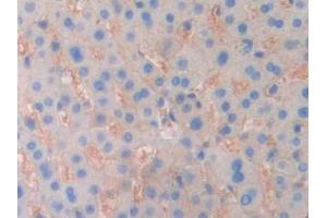 DAB staining on IHC-P; Samples: Human Liver cancer Tissue (ENPP1 Antikörper  (AA 625-780))