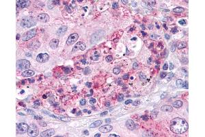 Anti-SGK3 antibody IHC of human Lung, Non-Small Cell Carcinoma. (SGK3 Antikörper  (Internal Region))