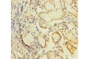 Immunohistochemistry of paraffin-embedded human gastric cancer using ABIN7157289 at dilution of 1:100 (KLHL26 Antikörper  (AA 366-615))