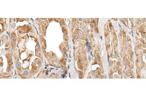 Immunohistochemistry of paraffin-embedded Human thyroid cancer tissue using PRNP Polyclonal Antibody at dilution of 1:45(x200) (PRNP Antikörper)