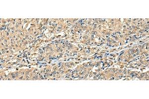 Immunohistochemistry of paraffin-embedded Human prost at e cancer tissue using CCDC112 Polyclonal Antibody at dilution of 1:45(x200) (CCDC112 Antikörper)