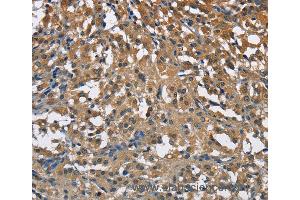 Immunohistochemistry of Human thyroid cancer using ENO1 Polyclonal Antibody at dilution of 1:40 (ENO1 Antikörper)