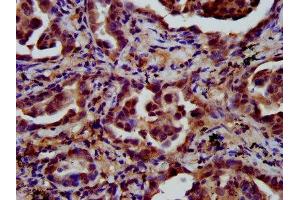 IHC image of ABIN7158226 diluted at 1:600 and staining in paraffin-embedded human lung cancer performed on a Leica BondTM system. (LIFR Antikörper  (AA 915-1086))