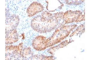 Formalin-fixed, paraffin-embedded human Prostate Carcinoma stained with AKR1C2 Mouse Monoclonal Antibody (CPTC-AKR1C2-1). (AKR1C2 Antikörper)