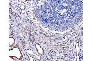 IHC analysis of MT-ND5 using anti-MT-ND5 antibody (ABIN7600145). (MT-ND5 Antikörper  (AA 154-570))