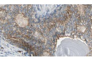 ABIN6274151 at 1/100 staining Human prostate tissue by IHC-P. (CKM Antikörper  (N-Term))