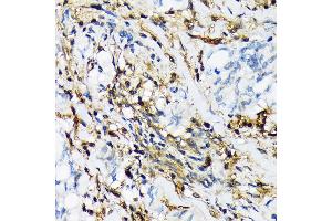 Immunohistochemistry of paraffin-embedded human lung cancer using PSMB9/LMP2 Rabbit mAb (ABIN7269596) at dilution of 1:100 (40x lens). (PSMB9 Antikörper)