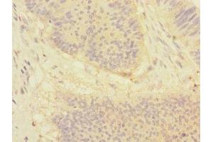 Immunohistochemistry of paraffin-embedded human colon cancer using ABIN7149768 at dilution of 1:100 (Desmocollin 1 Antikörper  (AA 480-690))