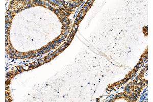 ABIN6260526 and ABIN6279316 at 1/100 staining Human ovarian cancer by IHC-P. (MCU Antikörper  (Internal Region))