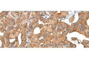 Immunohistochemistry of paraffin-embedded Human thyroid cancer tissue using INF2 Polyclonal Antibody at dilution of 1:40(x200) (INF2 Antikörper)