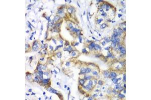 Immunohistochemistry of paraffin-embedded human liver cancer using RPL9 antibody. (RPL9 Antikörper  (AA 1-192))
