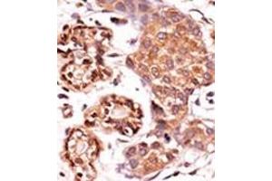 Formalin-fixed and paraffin-embedded human cancer tissue reacted with the primary antibody, which was peroxidase-conjugated to the secondary antibody, followed by AEC staining. (ABL2 Antikörper  (pTyr393, pTyr439))