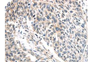 The image on the left is immunohistochemistry of paraffin-embedded Human lung cancer tissue using ABIN7191116(IQGAP2 Antibody) at dilution 1/40, on the right is treated with synthetic peptide. (IQGAP2 Antikörper)