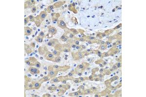 Immunohistochemistry of paraffin-embedded human liver cancer using GFM1 antibody at dilution of 1:100 (40x lens). (GFM1 Antikörper)