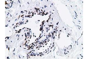 Immunohistochemical staining of paraffin-embedded Carcinoma of Human kidney tissue using anti-NT5DC1 mouse monoclonal antibody. (NT5DC1 Antikörper)
