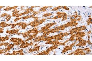 Immunohistochemistry of paraffin-embedded Human liver cancer tissue using Claudin 10 Polyclonal Antibody at dilution 1:50 (CLDN10 Antikörper)
