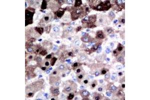 Immunohistochemical analysis of DGK iota staining in human liver cancer formalin fixed paraffin embedded tissue section.