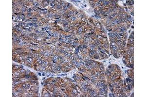 Immunohistochemical staining of paraffin-embedded Adenocarcinoma of colon tissue using anti-RALBP1 mouse monoclonal antibody. (RALBP1 Antikörper)