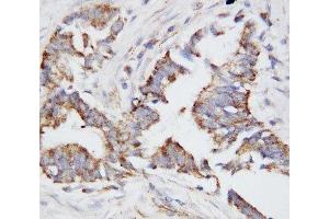 IHC-P: OPN antibody testing of human breast cancer tissue