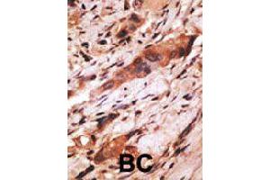 Formalin-fixed and paraffin-embedded human cancer tissue reacted with CD82 polyclonal antibody  , which was peroxidase-conjugated to the secondary antibody, followed by AEC staining. (CD82 Antikörper  (C-Term))