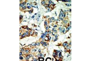 Formalin-fixed and paraffin-embedded human cancer tissue reacted with the primary antibody, which was peroxidase-conjugated to the secondary antibody, followed by AEC staining. (NEK4 Antikörper  (C-Term))