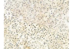 ABIN6263588 and ABIN6279411 at 1/100 staining human Hodgkin lymphoma by IHC-P.