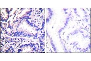 Immunohistochemistry analysis of paraffin-embedded human lung carcinoma tissue, using Synuclein gamma Antibody.