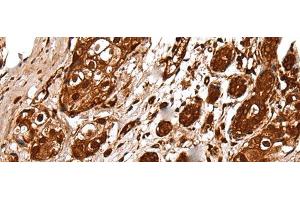 Immunohistochemistry of paraffin-embedded Human breast cancer tissue using UBE2V1 Polyclonal Antibody at dilution of 1:30(x200)