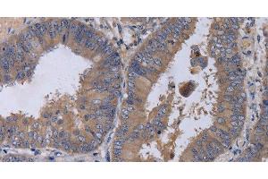 Immunohistochemistry of paraffin-embedded Human colon cancer tissue using MKKS Polyclonal Antibody at dilution 1:50 (MKKS Antikörper)