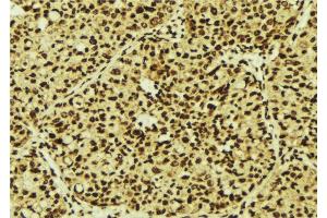 ABIN6277246 at 1/100 staining Human breast cancer tissue by IHC-P. (TNK2 Antikörper  (C-Term))