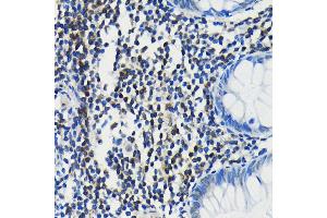 Immunohistochemistry of paraffin-embedded human colon using PIM1 antibody (ABIN7269375) at dilution of 1:100 (40x lens). (PIM1 Antikörper)