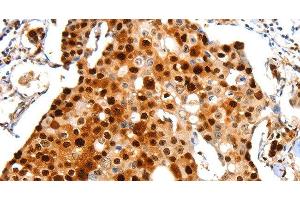 Immunohistochemistry of paraffin-embedded Human breast cancer using Proliferating Cell Nuclear Antigen Polyclonal Antibody at dilution of 1:44 (PCNA Antikörper)