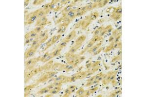 Immunohistochemistry of paraffin-embedded human liver cancer using HSPA9 antibody (ABIN5970207) at dilution of 1/100 (40x lens). (HSPA9 Antikörper)
