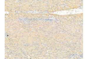 ABIN6255897 and ABIN6267456 at 1/100 staining human hepatocellular carcinoma by IHC-P.