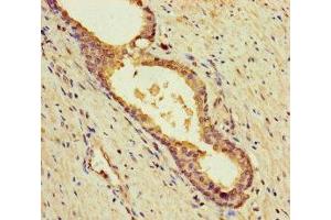 Immunohistochemistry of paraffin-embedded human prostate cancer using ABIN7145605 at dilution of 1:100 (MUTED Antikörper  (AA 2-187))