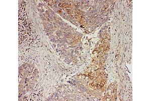 IHC-P: GRB7 antibody testing of human oesophagus squama cancer tissue