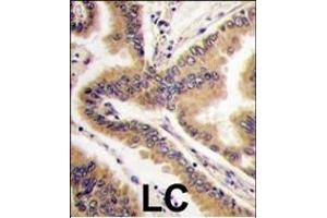 Formalin-fixed and paraffin-embedded human lung carcinoma tissue reacted with P38 delta antibody (C-term), which was peroxidase-conjugated to the secondary antibody, followed by DAB staining. (MAPK13 Antikörper  (C-Term))