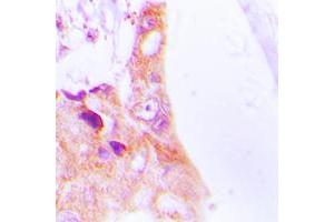Immunohistochemical analysis of Cytokeratin 8 staining in human lung cancer formalin fixed paraffin embedded tissue section. (KRT8 Antikörper  (Center))