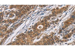 Immunohistochemistry of paraffin-embedded Human gasrtic cancer tissue using CYP21A2 Polyclonal Antibody at dilution 1:60