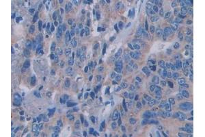 Detection of SEMA3A in Human Colorectal cancer Tissue using Polyclonal Antibody to Semaphorin 3A (SEMA3A) (SEMA3A Antikörper  (AA 580-664))