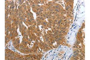 The image on the left is immunohistochemistry of paraffin-embedded Human ovarian cancer tissue using ABIN7191700(NPY1R Antibody) at dilution 1/25, on the right is treated with synthetic peptide.