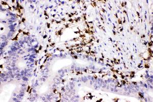 Cathepsin G was detected in paraffin-embedded sections of human intestinal cancer tissues using rabbit anti- Cathepsin G Antigen Affinity purified polyclonal antibody (Catalog # ) at 1 ? (Cathepsin G Antikörper  (AA 25-252))