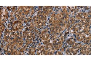 Immunohistochemistry of paraffin-embedded Human thyroid cancer tissue using LLGL1 Polyclonal Antibody at dilution 1:40 (LLGL1 Antikörper)