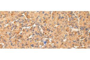 Immunohistochemistry of paraffin-embedded Human liver cancer tissue using AQP7 Polyclonal Antibody at dilution 1:40 (Aquaporin 7 Antikörper)